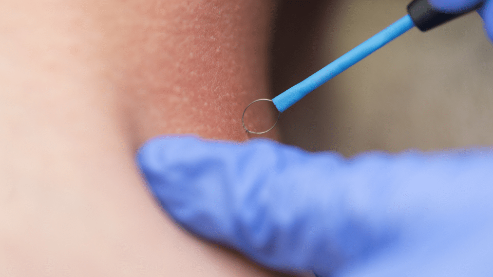 A gloved hand, likely belonging to a female skin doctor at a skin cancer clinic, uses a metal extraction tool on a person's skin, possibly for removing blackheads or spots.