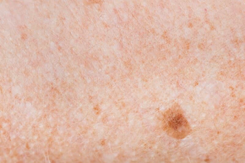 freckled skin