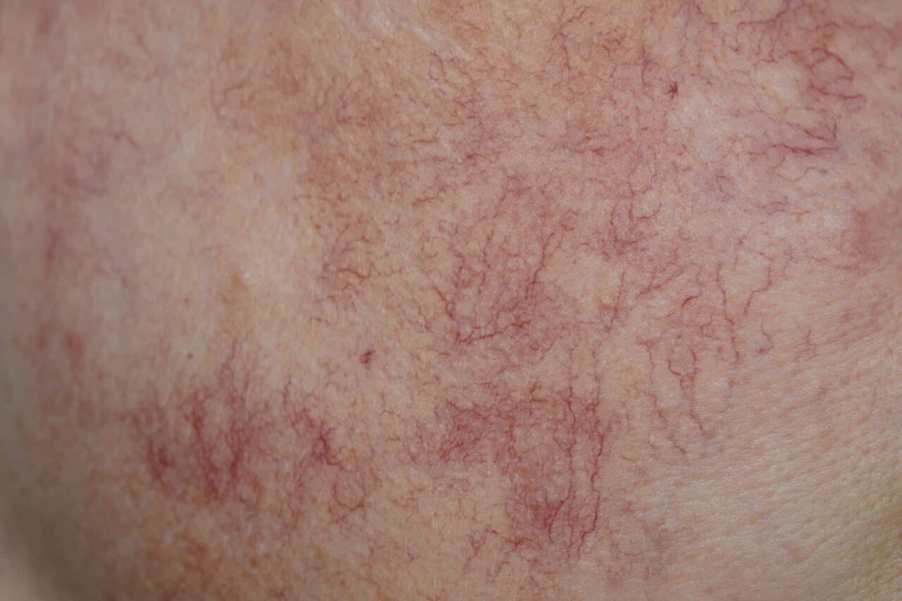 Close-up of human skin showing visible red spider veins, a network of broken capillaries, and signs of deep vascular lesions.