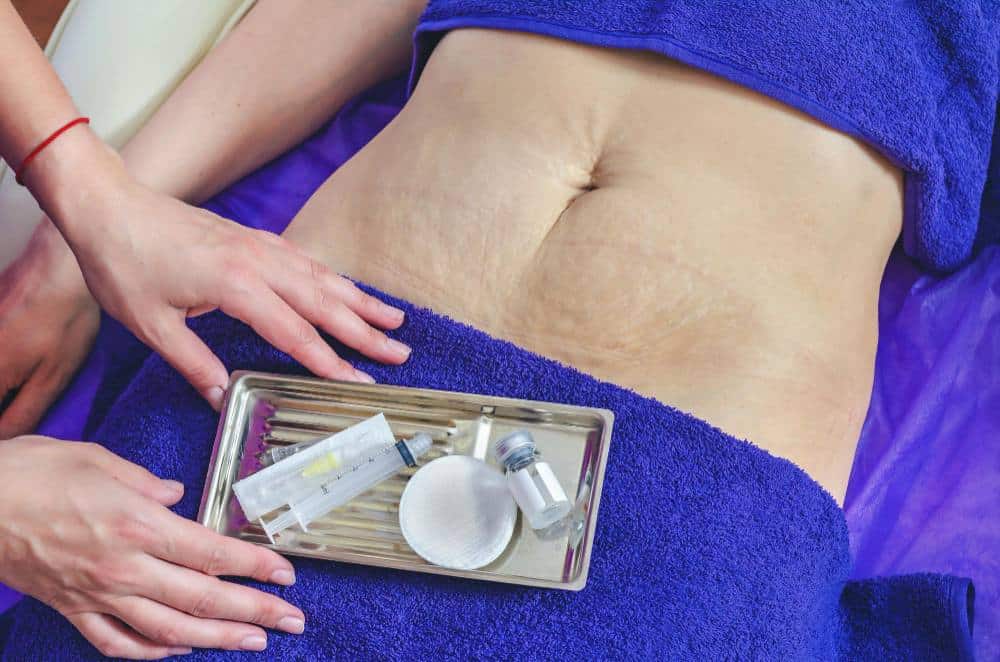 A person lying down with a blue towel covering their chest and lower body, exposing their abdomen. A tray with medical or cosmetic instruments is placed on the towel for stretch marks treatment.