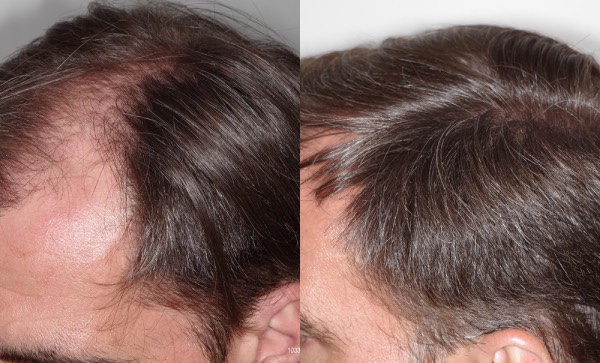 Hair restoration before and after