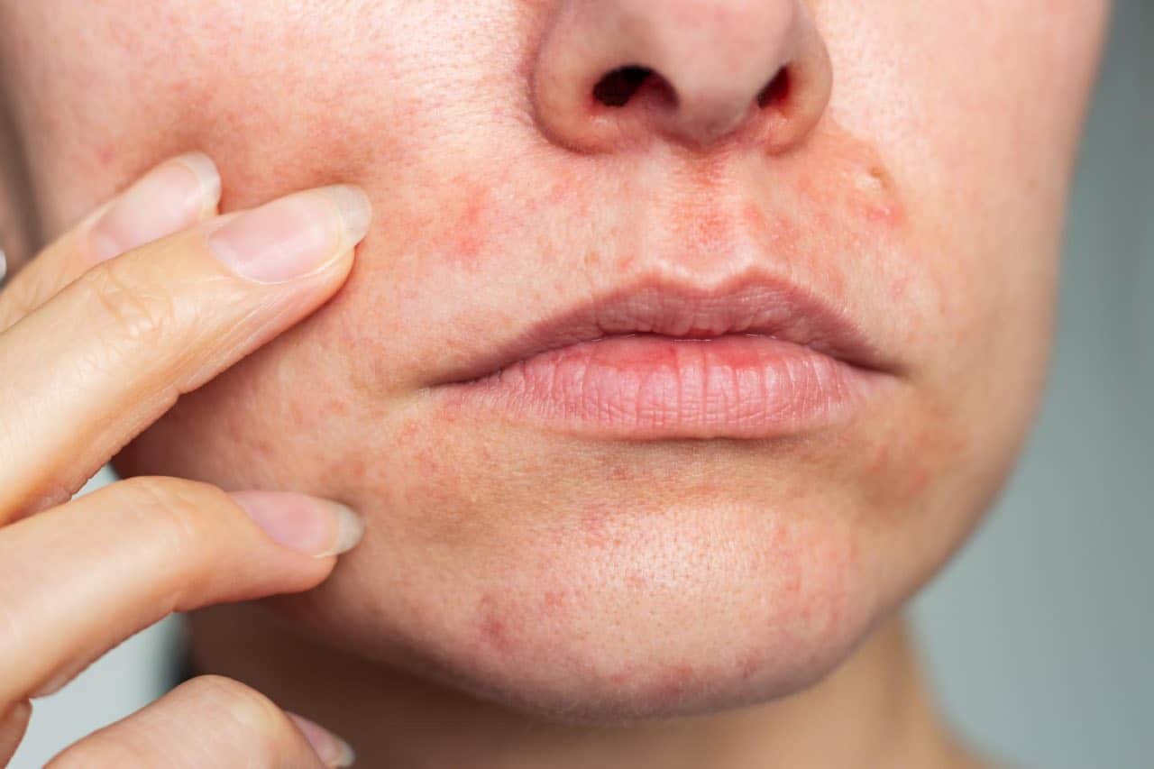 Close-up of a person’s lower face showing red, irritated skin around the mouth and chin after using unsuitable cosmetic.