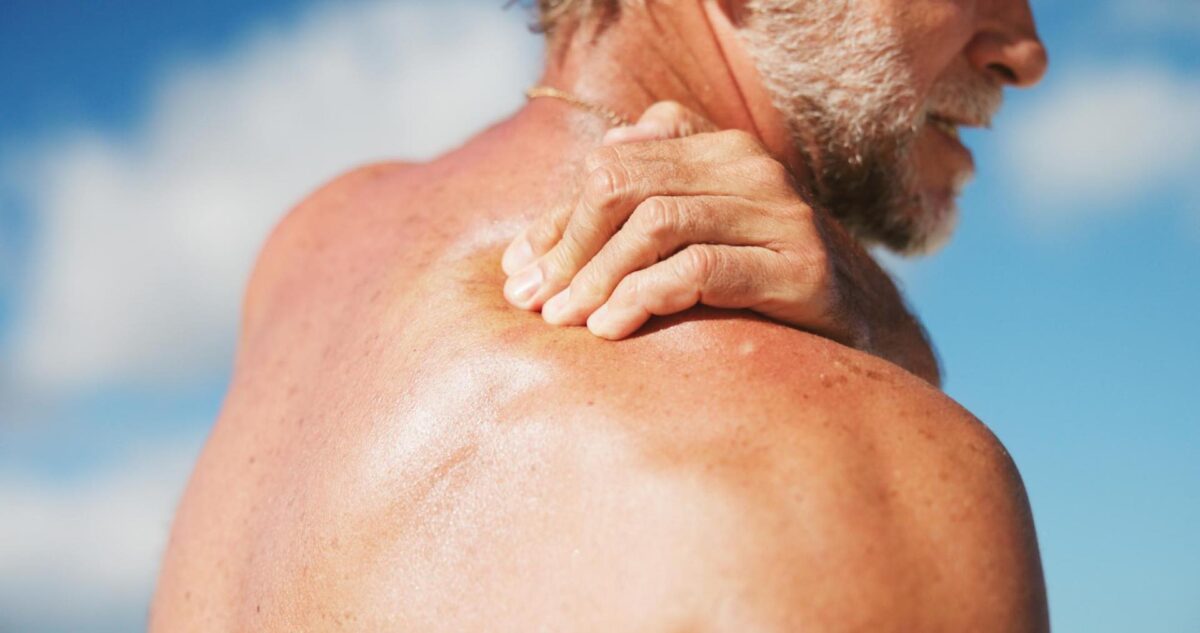 A man holding his sunburnt shoulder, showing red and irritated skin, with a blue sky in the background.