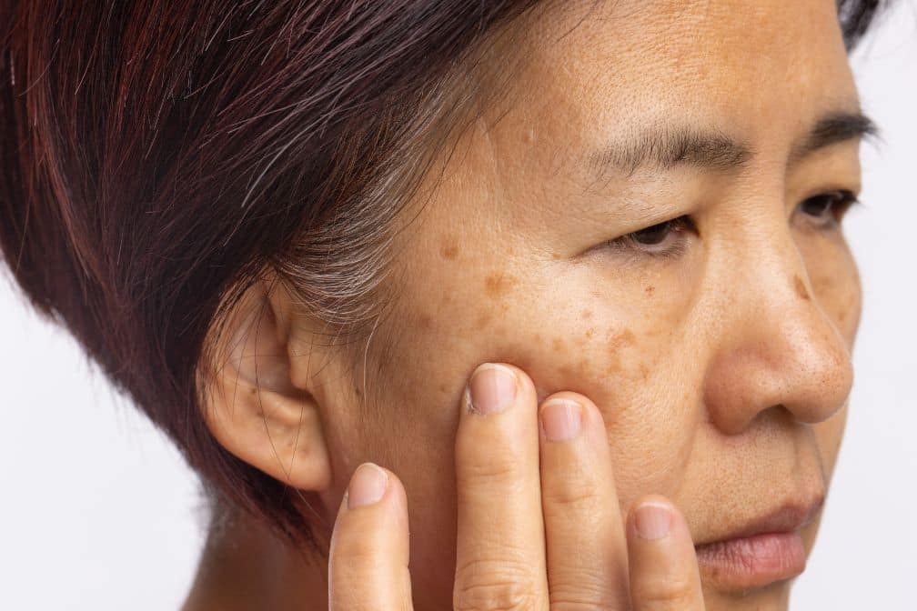 A middle-aged woman touches the side of her face, looking worried about hormonal melasma, with visible dark spots and hyperpigmentation on her cheek.