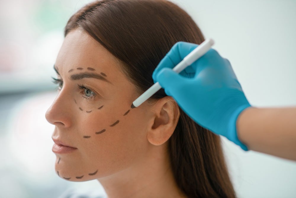 A person with marked lines on their face prepares for PDO threads face lift procedure.