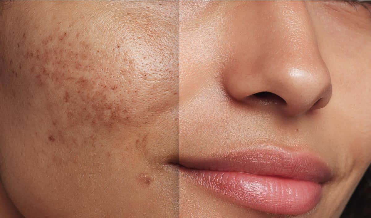 Split-screen comparison of a person’s cheek showing hyperpigmentation on the left and clearer skin on the right.