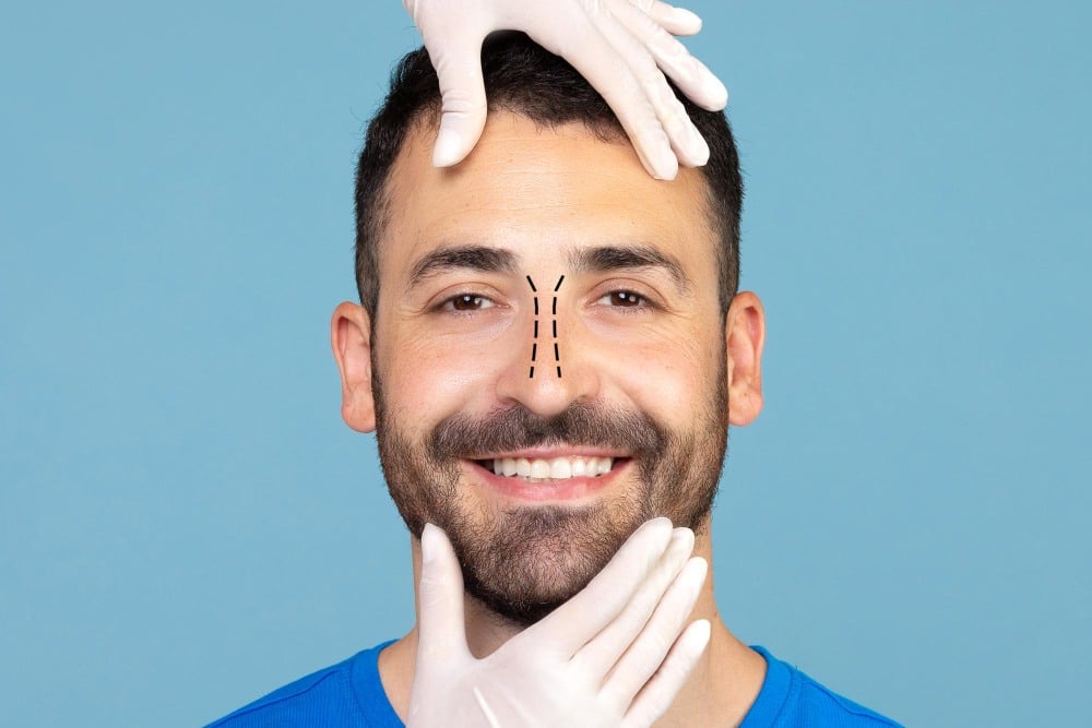 Smiling man with surgical markings on his nose; gloved hands frame his face, suggesting preparation for a Non-Surgical Rhinoplasty procedure.