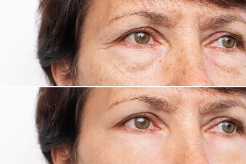 mature woman with sun damaged skin -before and after treatment