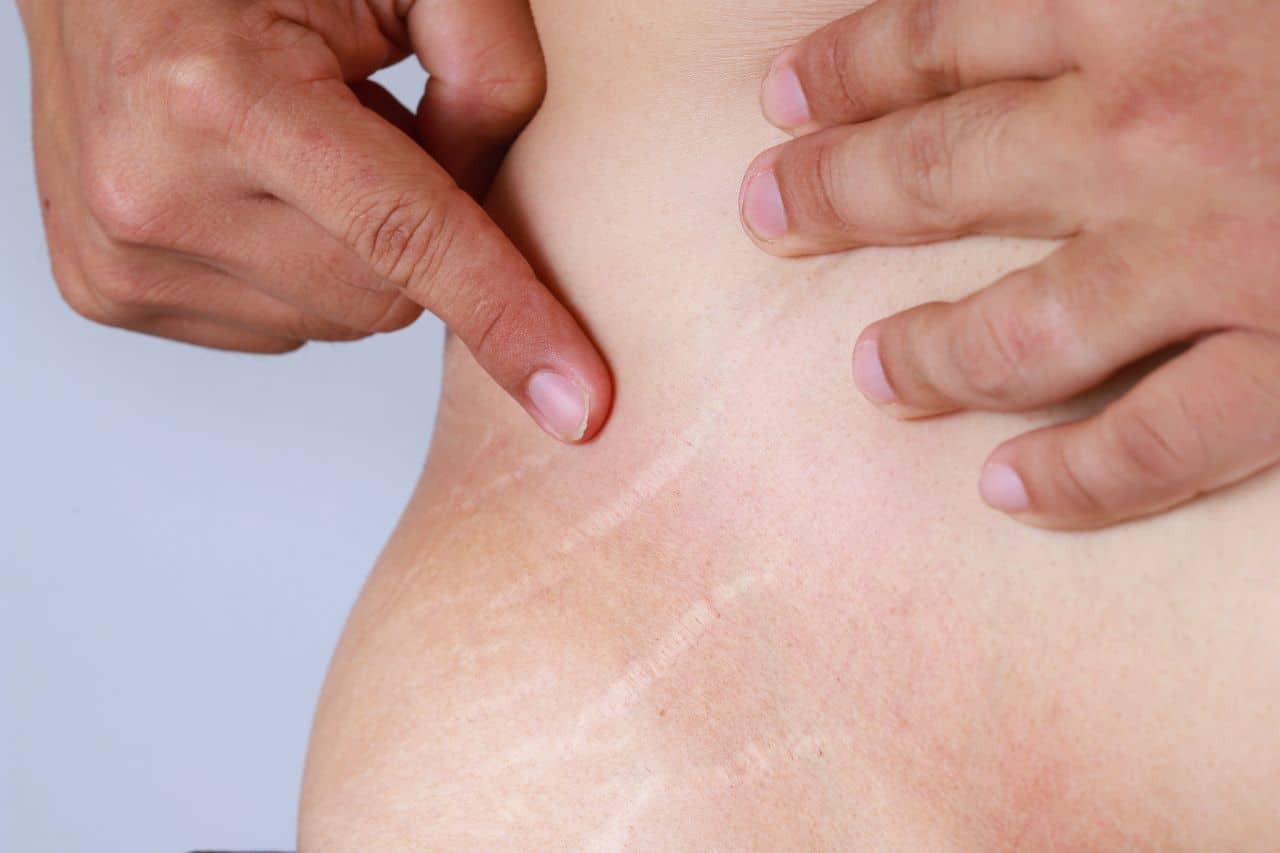 A person points to stretch marks on the skin of their side or lower back, highlighting several light, linear marks.