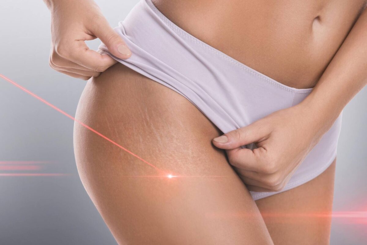 A person in light underwear exposes their hip, showing stretch marks while a red laser light is directed at the skin, suggesting a cosmetic treatment.