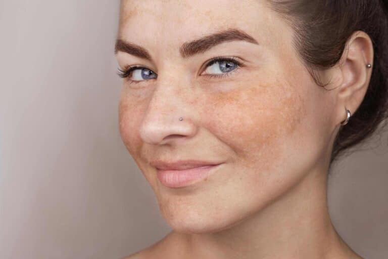 A woman-with-pigmentation-skin-requiring-treatment with blue eyes, light skin, visible freckles, and subtle make-up looks at the camera; she has a nose stud and small hoop earrings.