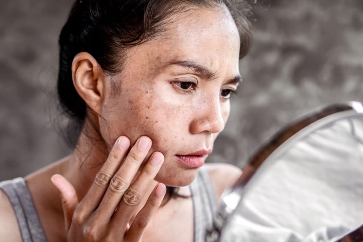 A woman-with-skin-pigmentation-hormonal-melasma looks at her face in a mirror, touching her cheek and examining dark spots and acne scars on her skin.