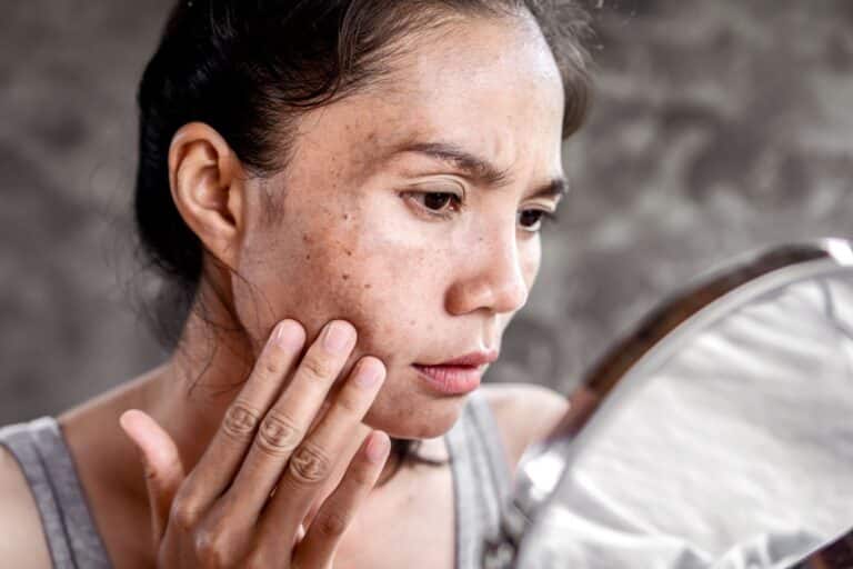 A woman-with-skin-pigmentation-hormonal-melasma looks at her face in a mirror, touching her cheek and examining dark spots and acne scars on her skin.