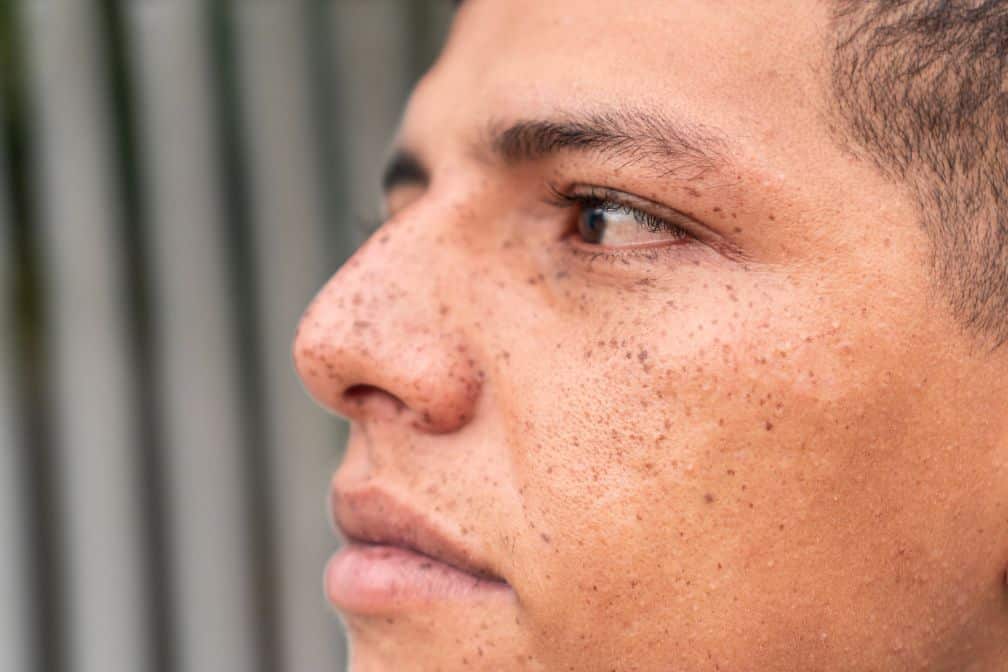 Close-up side view of a young man with sun-induced pigmentation freckles, showing skin with visible pores against a blurred background of vertical lines.