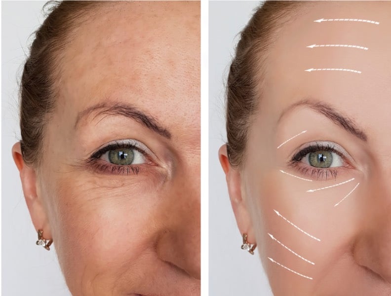 antiwrinkle injection before and after 4