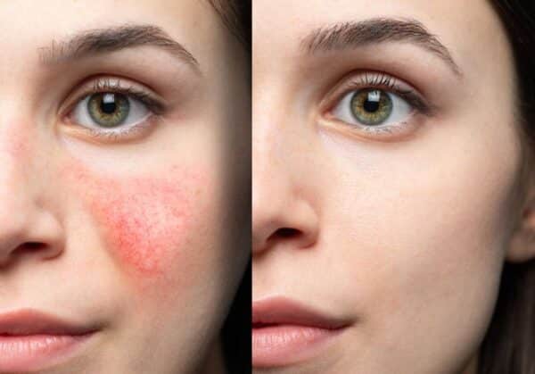 comparing healthy skin and face suffering rosacea