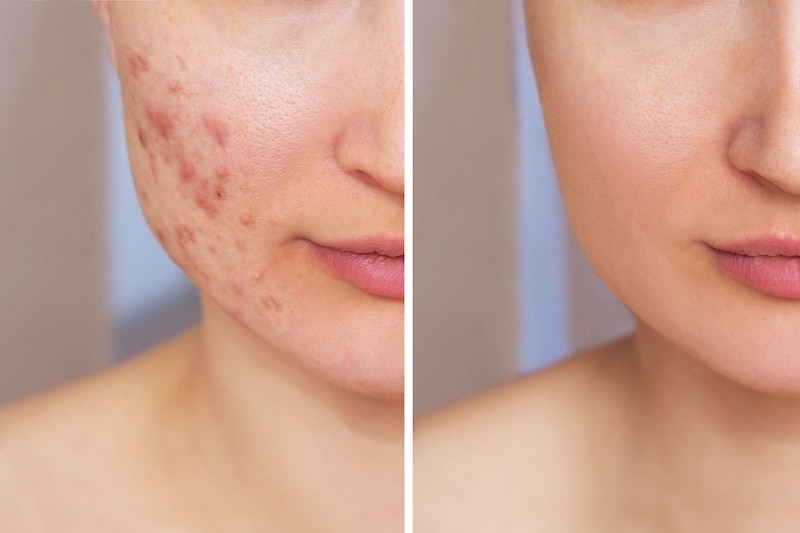 woman, acne, redness, bumps, inflammation