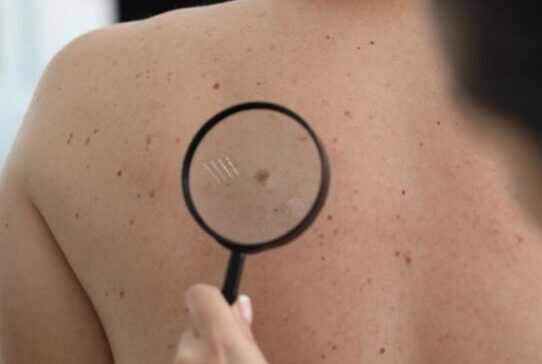 doctor examines birthmark of patient on back for any skin cancer risk