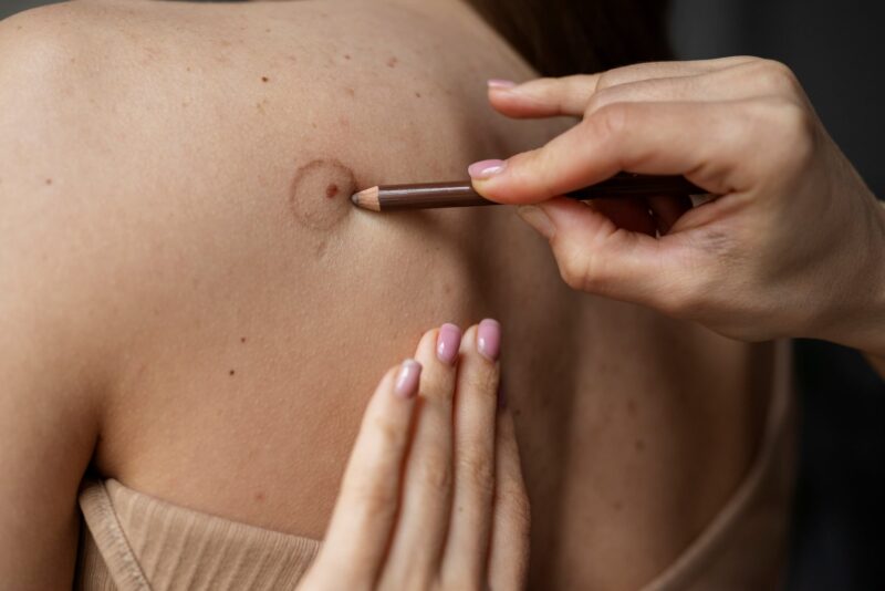 doctor diagnosing melanoma on a female body before excision