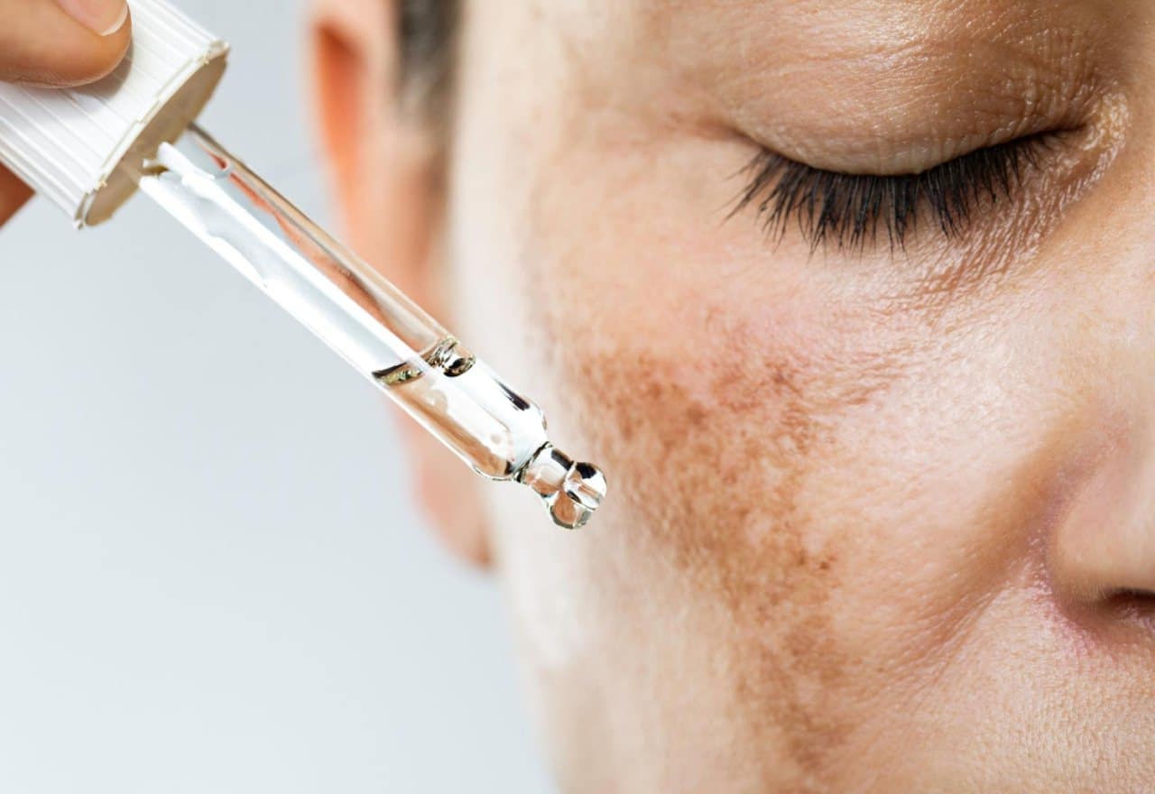 A hand holds a glass dropper filled with clear serum near a person’s cheek with visible skin discolouration.