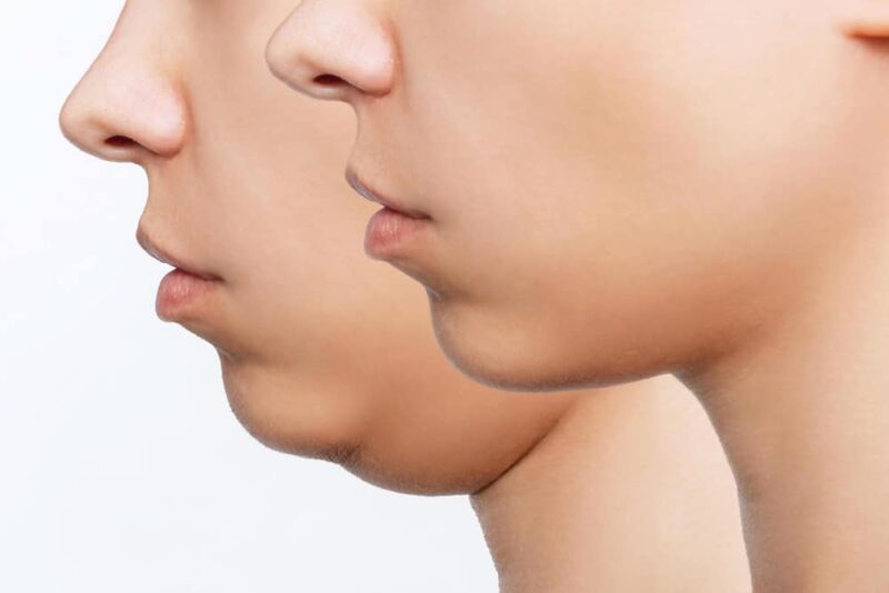 liposuction-double-chin-woman-face-with-chin-before-after-cosmetic-plastic-surgery-profile