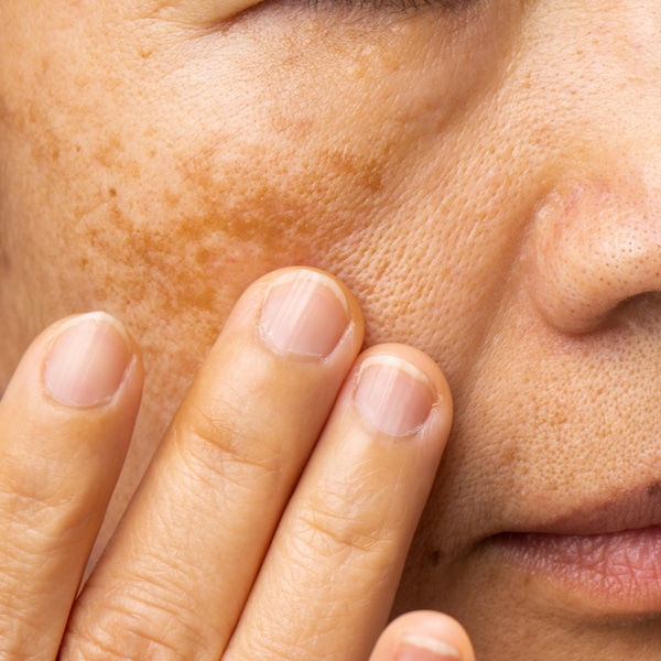 dark patches, spots, melasma, medical condition