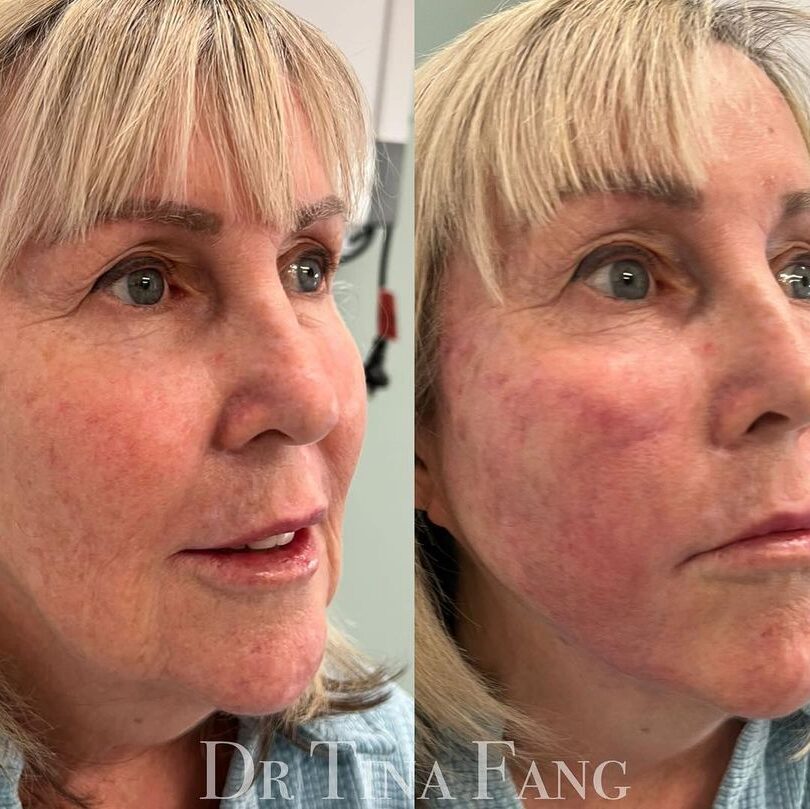 PRP treatment Before and after_2