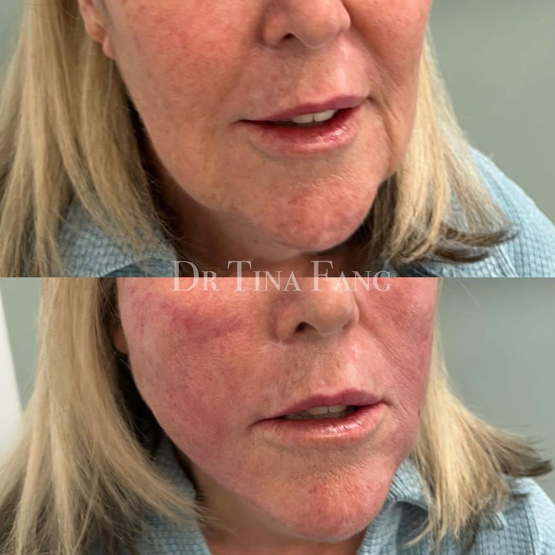 PRP treatment Before and after_1