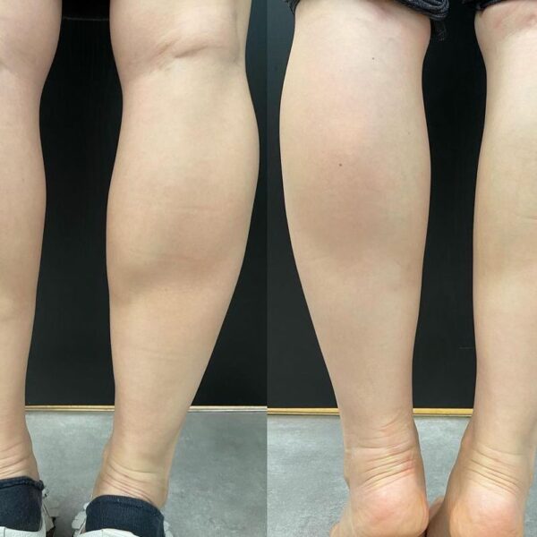 Calf Slimming before and after