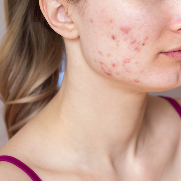 woman, acne, redness, bumps, inflammation