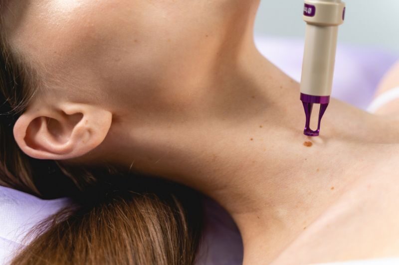 a young woman getting mole removed